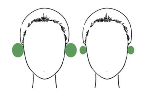 贴发耳影响耳朵美观