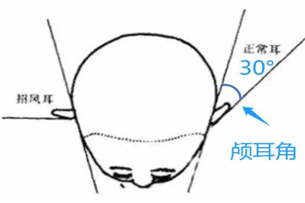 贴发耳耳颅夹角太小