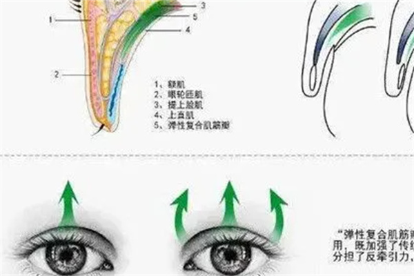 额肌提吊术治疗上睑下垂提升术