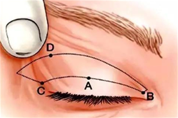 额肌提吊术治疗上睑下垂提升同步拉提