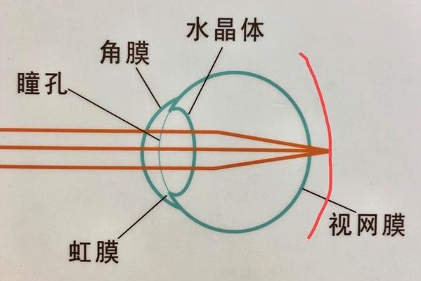 离焦软镜和角膜塑形镜区别都有哪些？