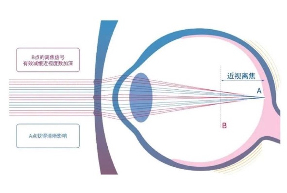 离焦软镜和角膜塑形镜区别都有哪些？