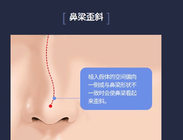 韩国ts整形外科鼻修复做的好，针对假体移位/鼻梁过高/包膜挛缩等情况