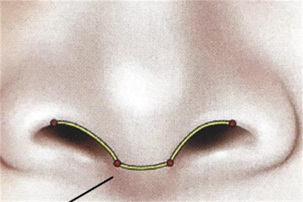 海鸥线鼻子是怎样的
