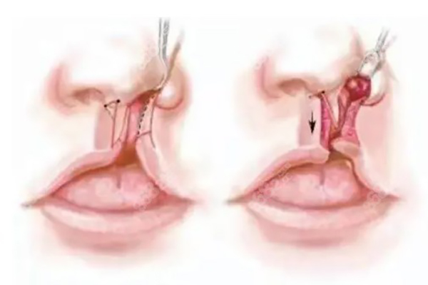 唇腭裂需要做几次手术