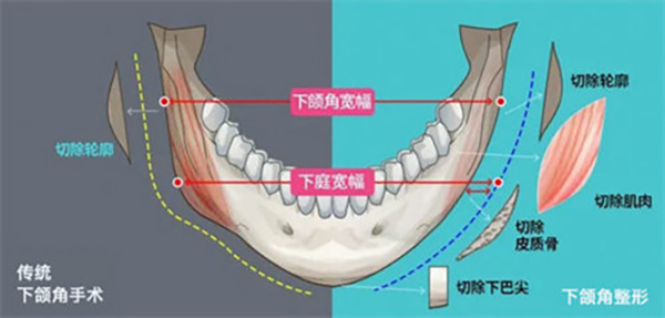 张笑天下颌角技术怎么样