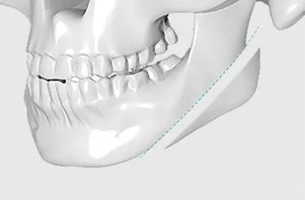 下颌角一刀切