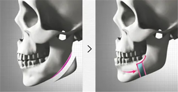 下颌角整形