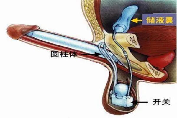 男性勃起功能障碍