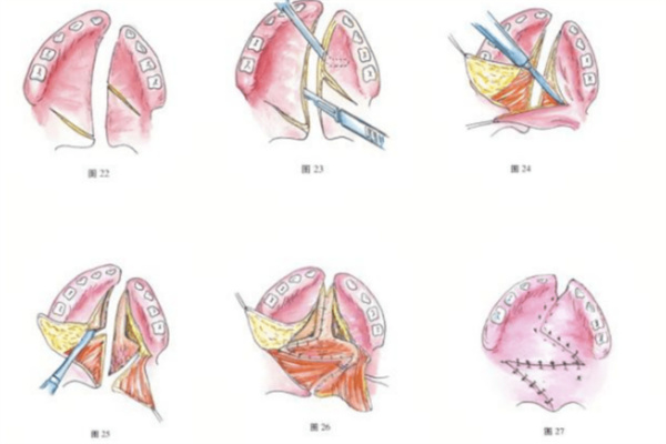 腭裂手术治疗