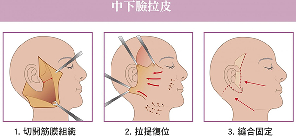 筋膜悬吊面部提升术怎么做