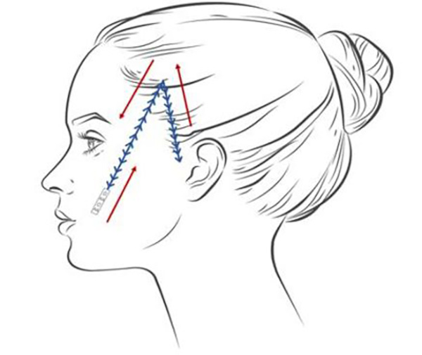 筋膜悬吊面部提升术多久有效