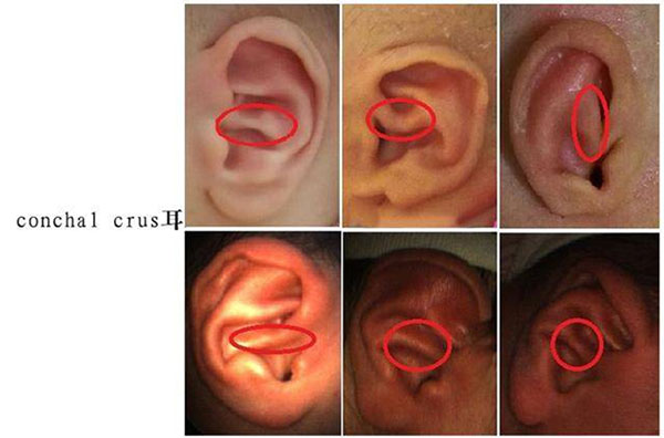 8种耳廓畸形图片