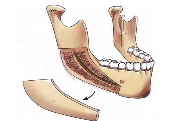 下颌角劈外板脸会垮？