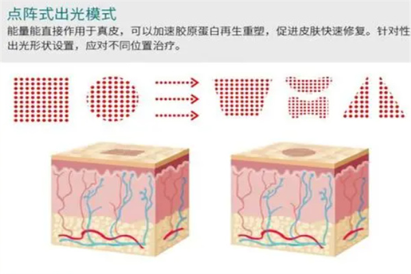 点阵激光祛痘