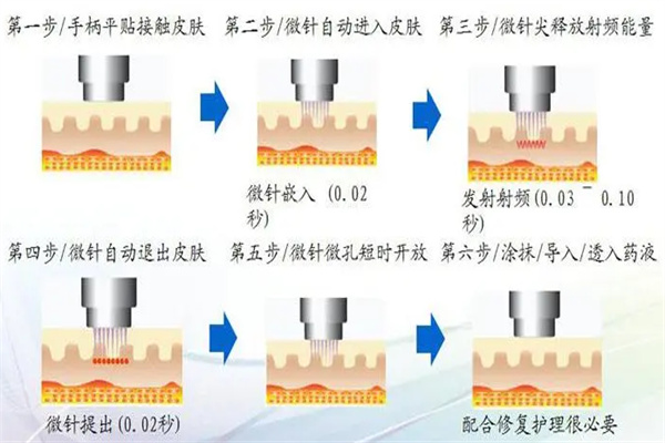 射频微针祛痘