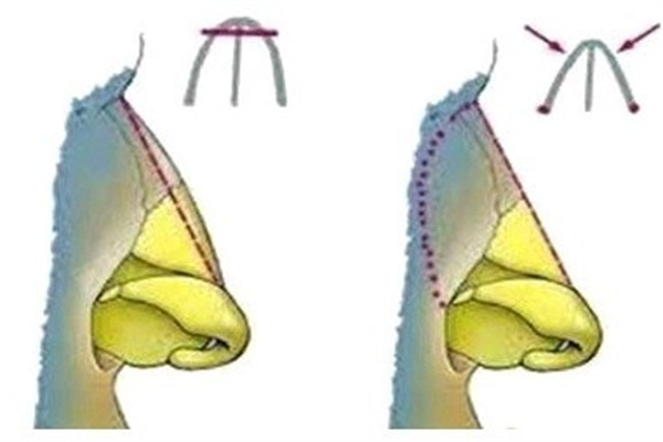 鼻小柱凹陷挛缩