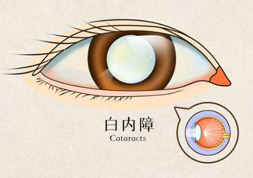 白内障晶体植入能管多少年