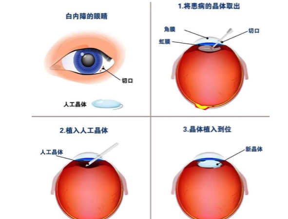 白内障手术什么时候做较好？