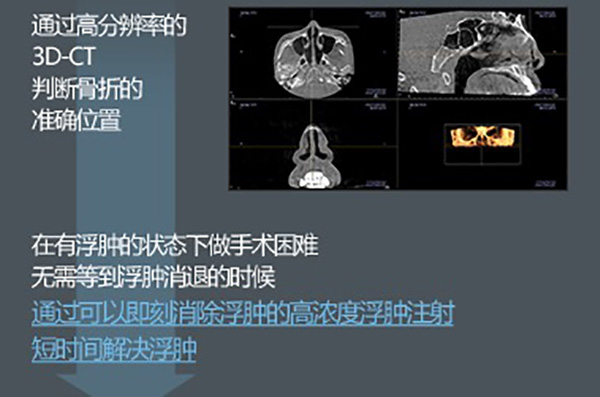 鼻骨骨折复位术属于几级手术？韩国GNG整形医院一天完成鼻骨骨折复位术