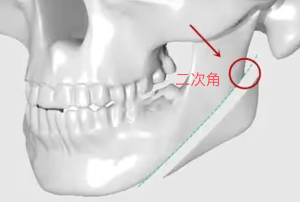 下颌角二次角是什么意思？看韩国TS整形外科李相均如何避免二次角