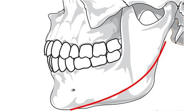 下颌角二次角是什么意思？看韩国TS整形外科李相均如何避免二次角