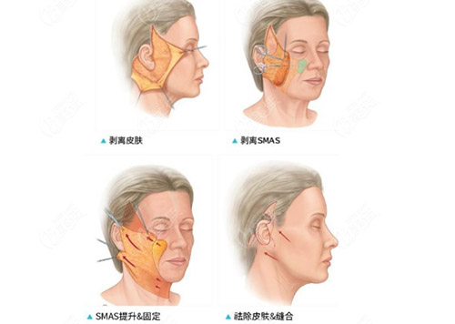 拉皮手术示意图