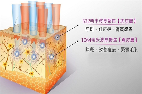 皮秒激光与点阵激光的能量不同