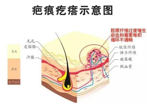 疤痕疙瘩示意图