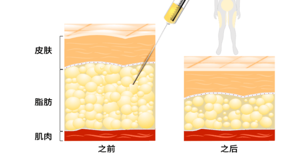 面部吸脂