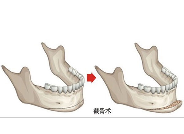 颧骨内推