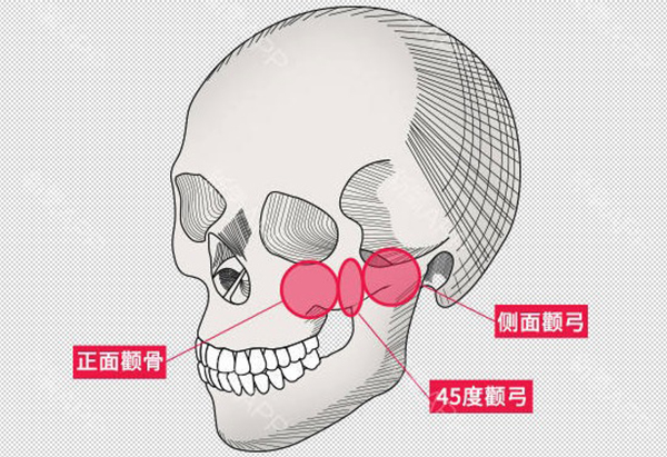 颧骨内推后骨头还能长到一起吗