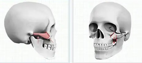 颧骨内推后骨头还能长到一起吗