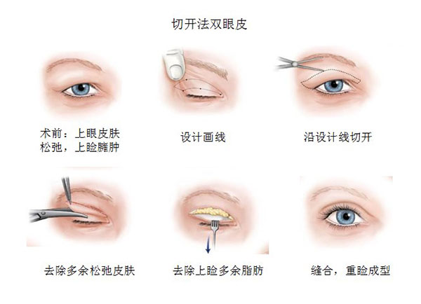 双眼皮