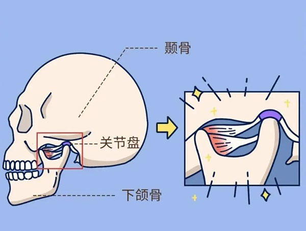 颞下颌关节紊乱