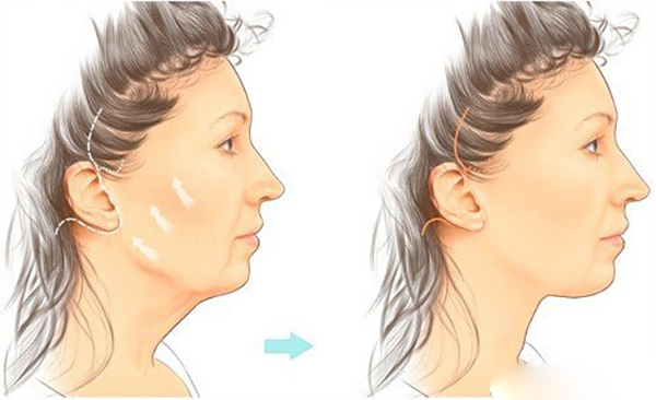 筋膜悬吊小切口紧致提升手术多少钱