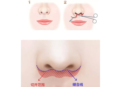 人中缩短术操作步骤