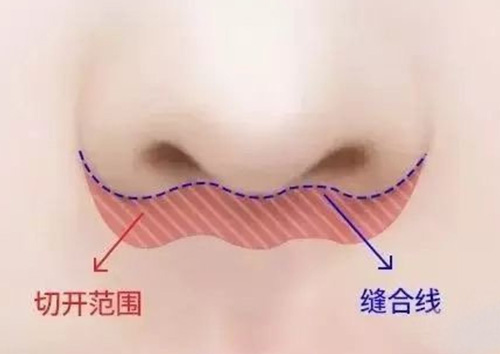 人中缩短术切口位置