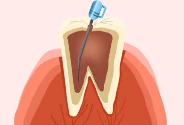 根管治疗