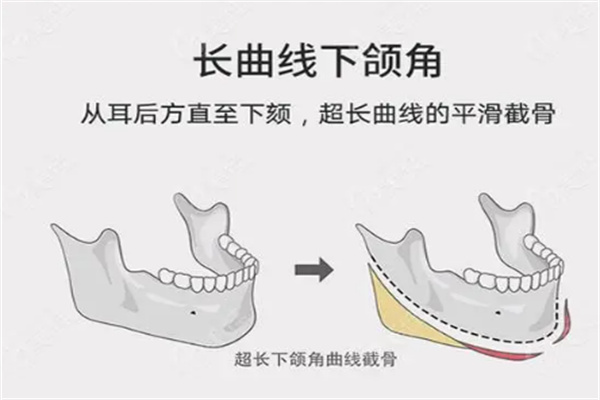 高俊明医生长曲线下颌角磨骨