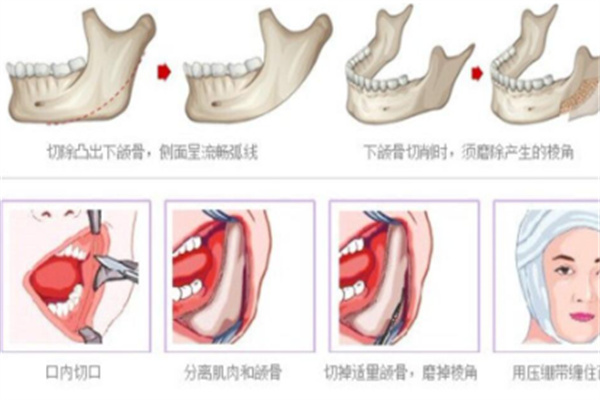 高俊明医生口腔囊袋缝合技术