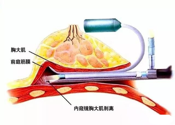 重庆安可忍医生傲蜜美胸2.0