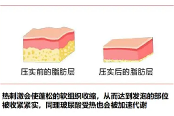 治疗馒化脸后压实脂肪