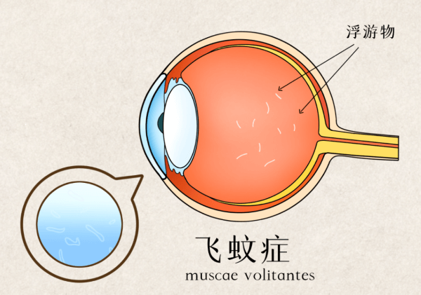 飞蚊症现象