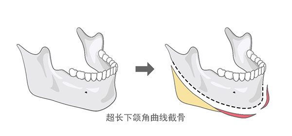 都说磨骨会有生命危险风险大吗