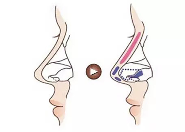 垫鼻梁有几种方法