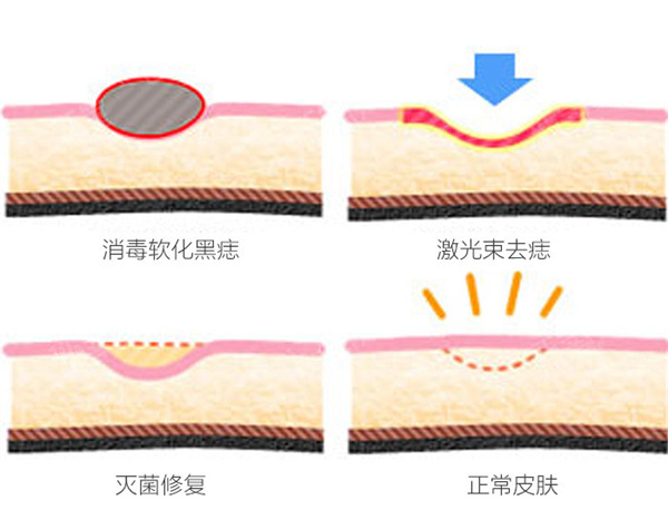 身上有痣怎么办才能去掉