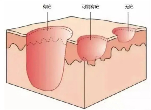 如何预防痣的恶变？