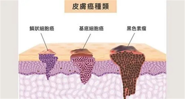 如何预防痣的恶变？