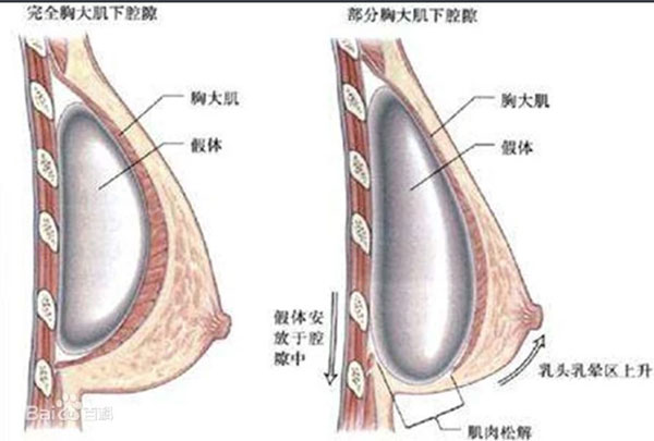 双平面假体隆胸